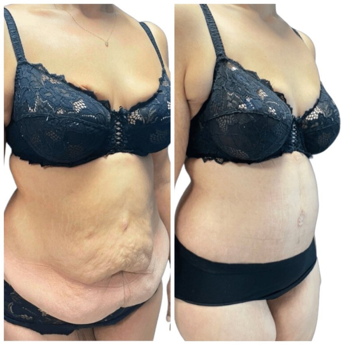 Before and after tummy tuck results at Michaël Benoilid Plastic and Cosmetic Surgeon Paris France