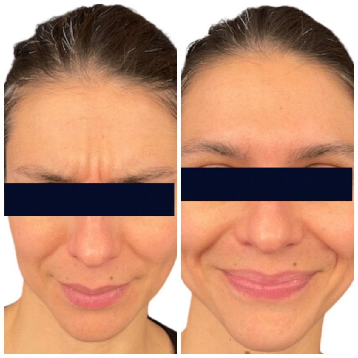 Before and after Botox injections results at Michaël Benoilid Plastic and Cosmetic Surgeon Paris France