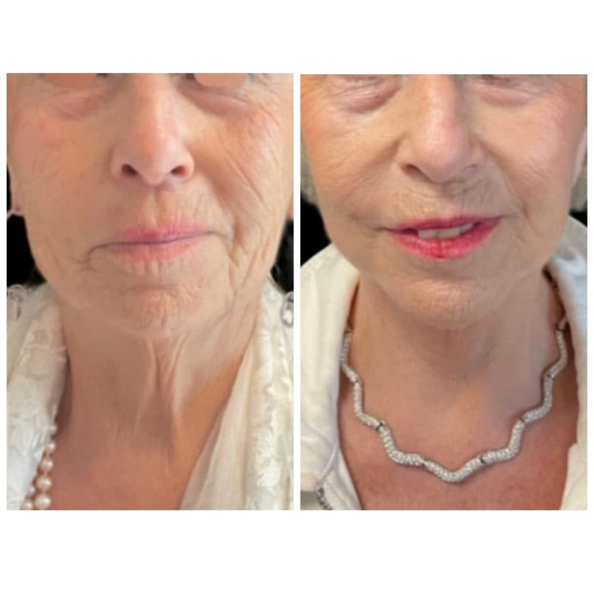 نتائج شد الوجه قبل وبعد في Michaël Benoilid Plastic and Cosmetic Surgeon باريس فرنسا