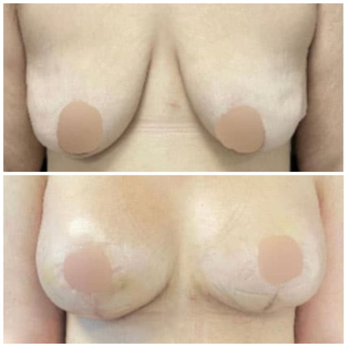 Before and after breast lift with implants round results at Michaël Benoilid Plastic Surgeon Paris