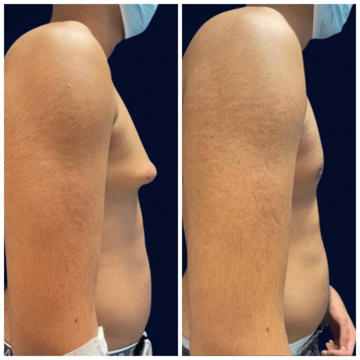 Результати до і після операції гінекомастії в Michaël Benoilid Plastic Surgeon Paris France
