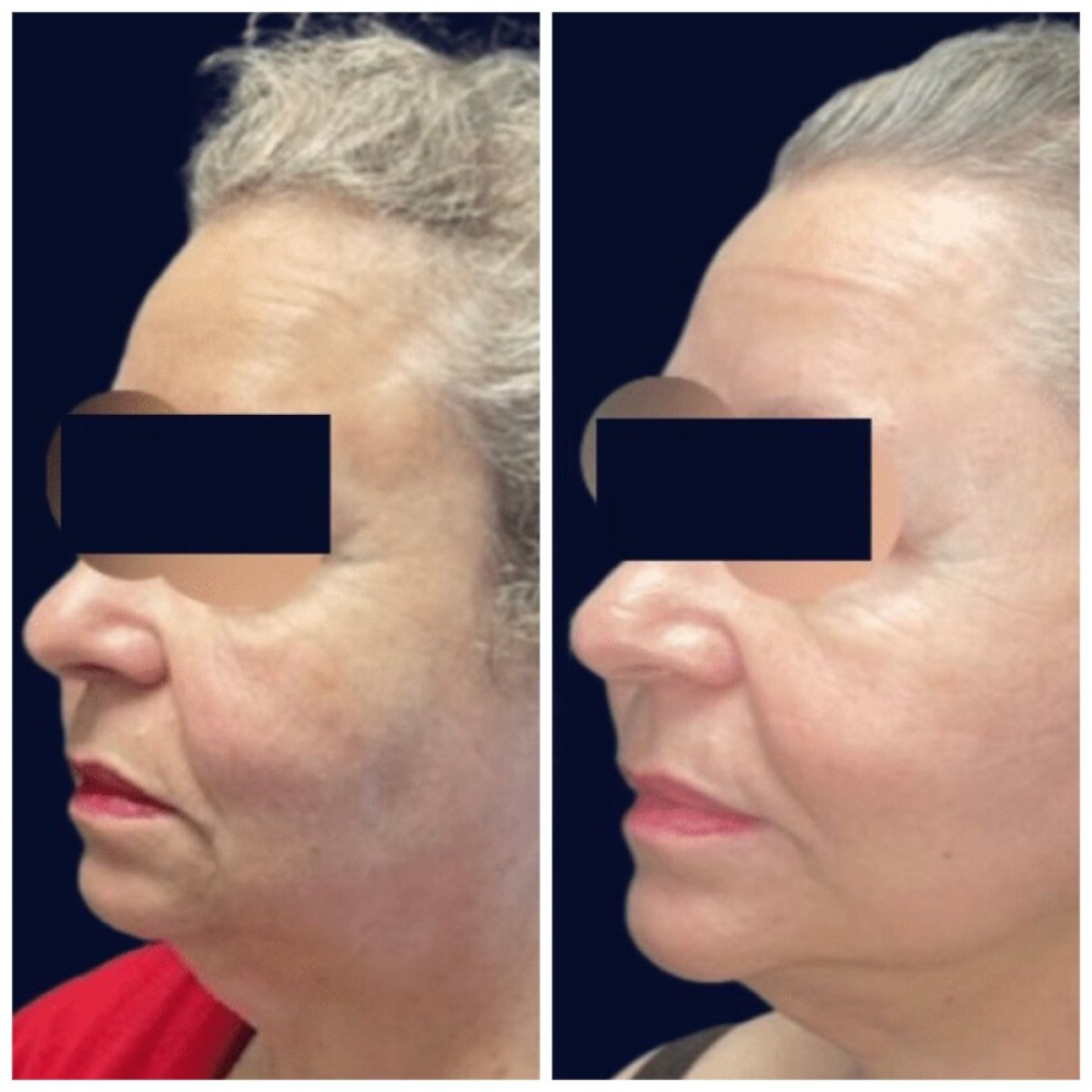 Facelift before and after results at Michaël Benoilid Plastic and Cosmetic Surgeon Paris France