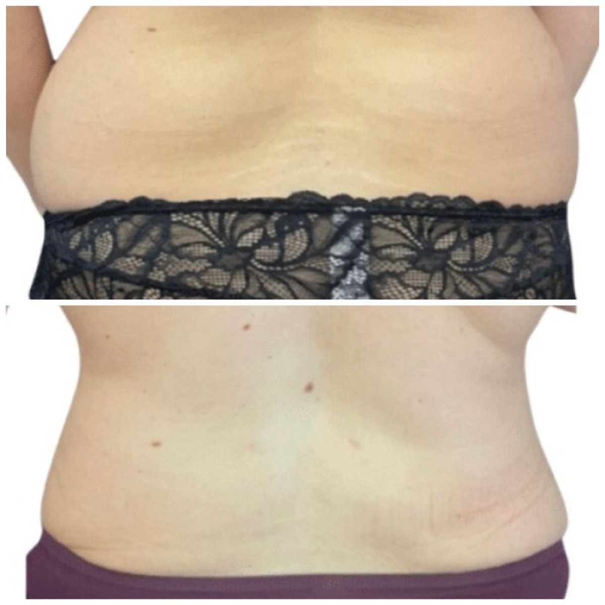 Before and after liposuction results at Michaël Benoilid Plastic and Cosmetic Surgeon Paris France