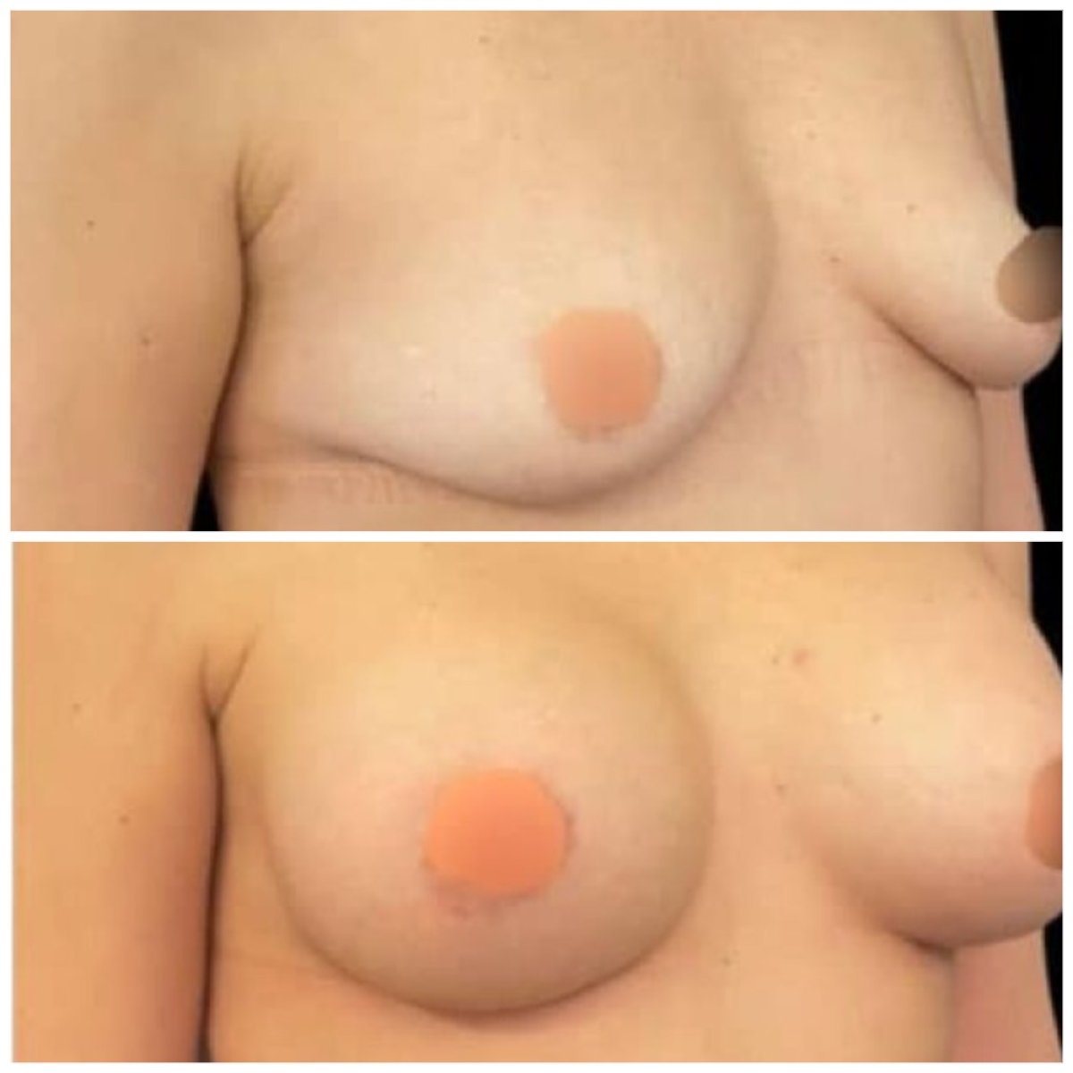 نتائج قبل وبعد تكبير الثدي في Michaël Benoilid Plastic Surgeon Paris France