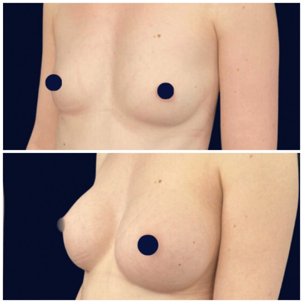 Before and after breast augmentation results at Michaël Benoilid Plastic and Cosmetic Surgeon Paris
