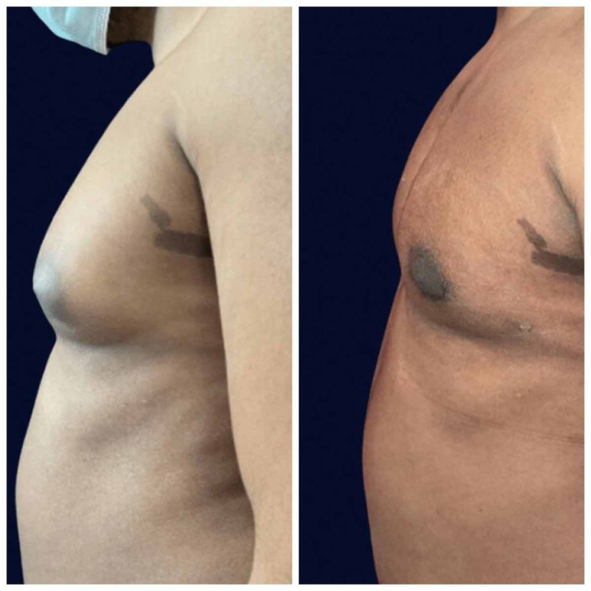 Before and after gynecomastia surgery results at Michaël Benoilid Plastic Surgeon Paris France