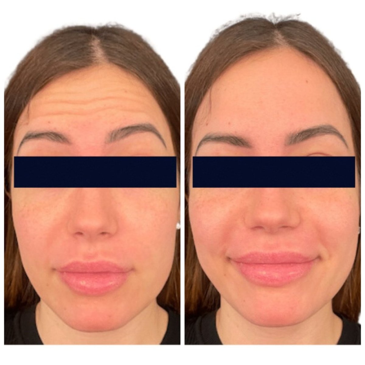 Before and after Botox injections results at Michaël Benoilid Plastic and Cosmetic Surgeon Paris France