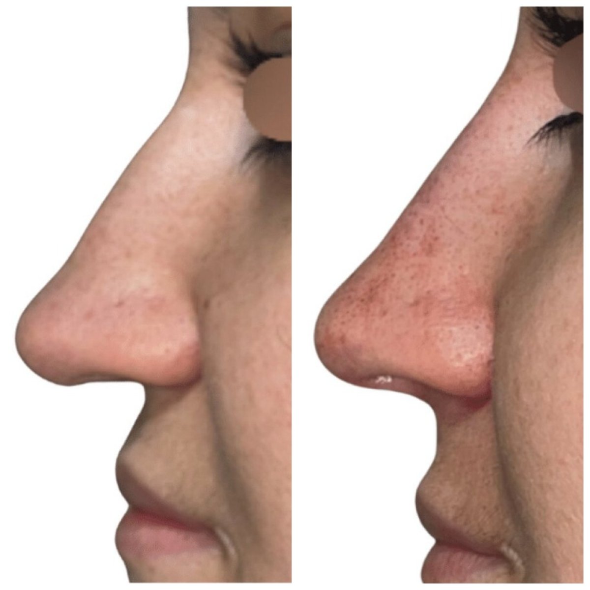 Before and after rhinoplasty results at Michaël Benoilid Plastic and Cosmetic Surgeon Paris France
