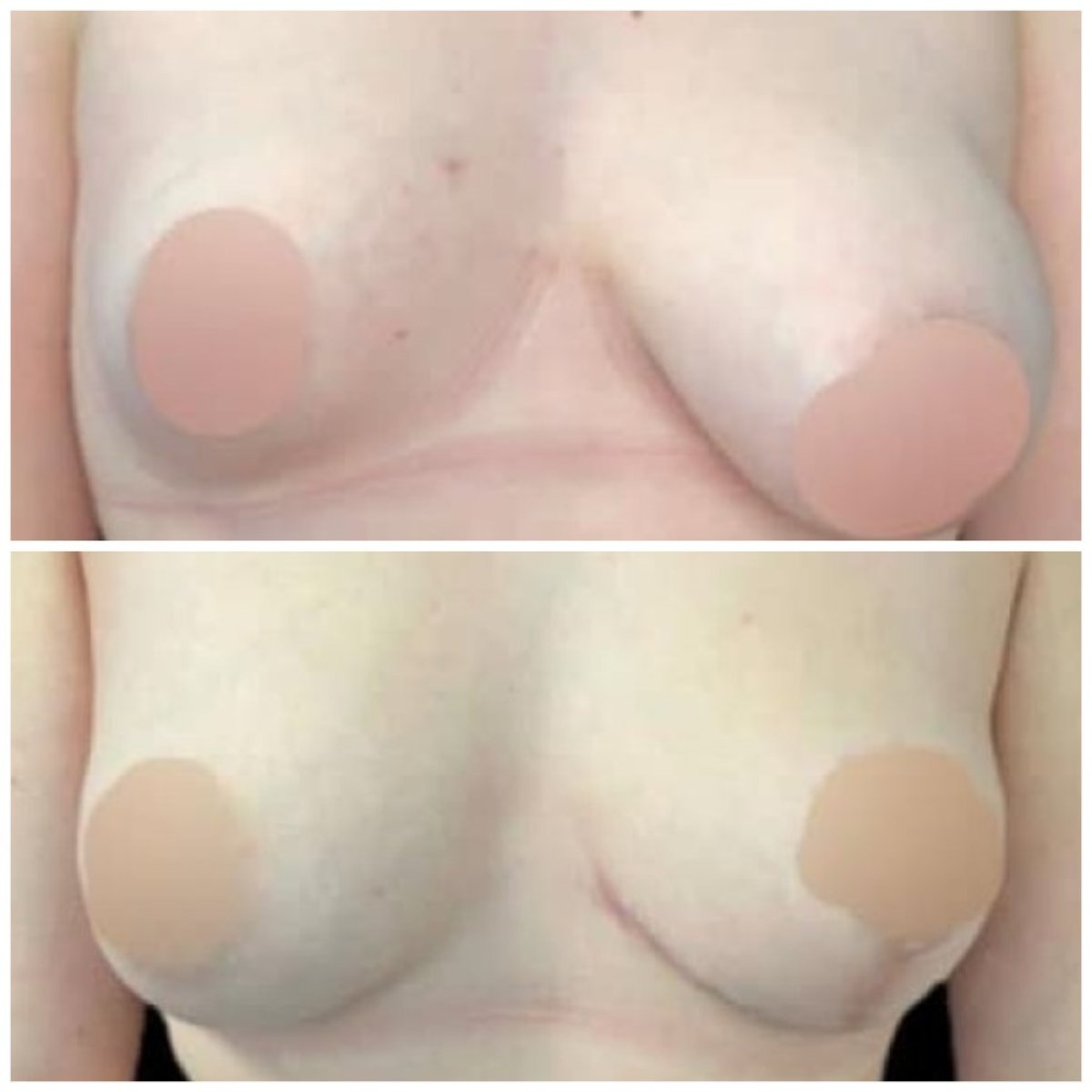 نتائج قبل وبعد تكبير الثدي في Michaël Benoilid Plastic and Cosmetic Surgeon Paris