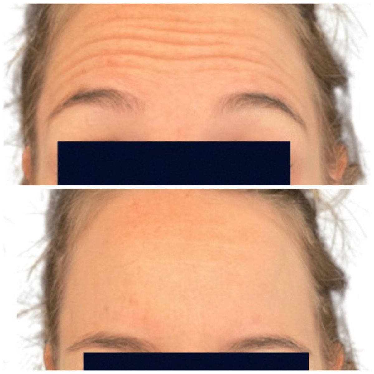 نتائج قبل وبعد حقن البوتوكس لتجاعيد الجبهة في Michaël Benoilid Plastic Surgeon Paris