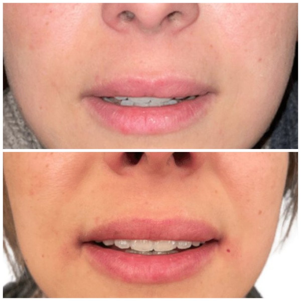 نتيجة قبل وبعد حقن الفيلر في Michaël Benoilid Plastic and Cosmetic Surgeon Paris France