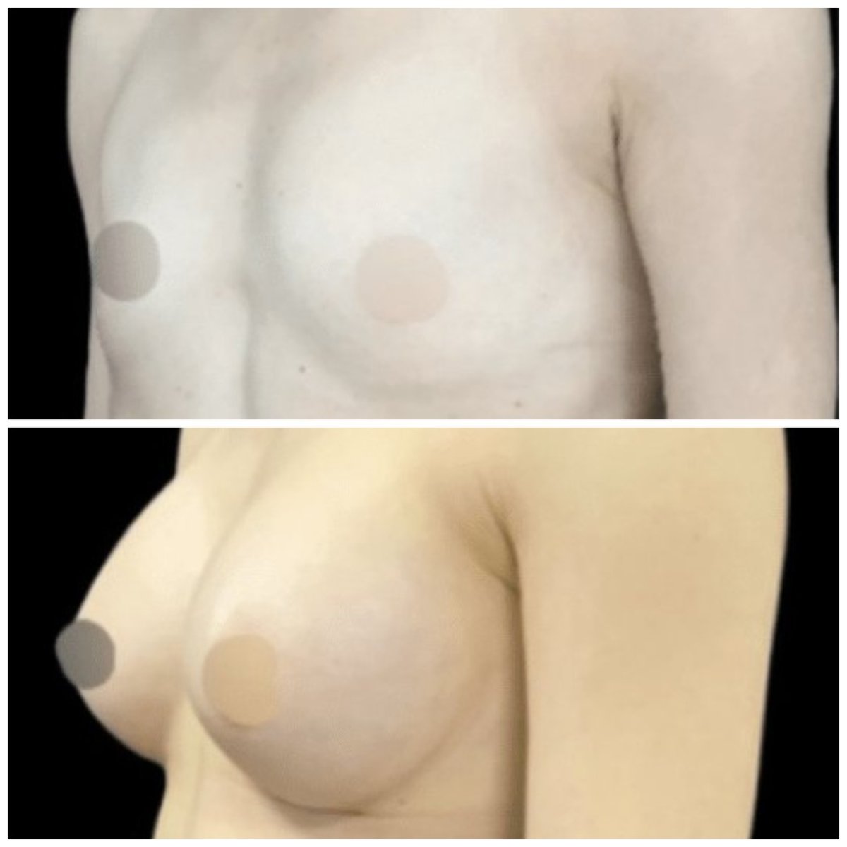 Before and after breast augmentation results at Michaël Benoilid Plastic and Cosmetic Surgeon Paris