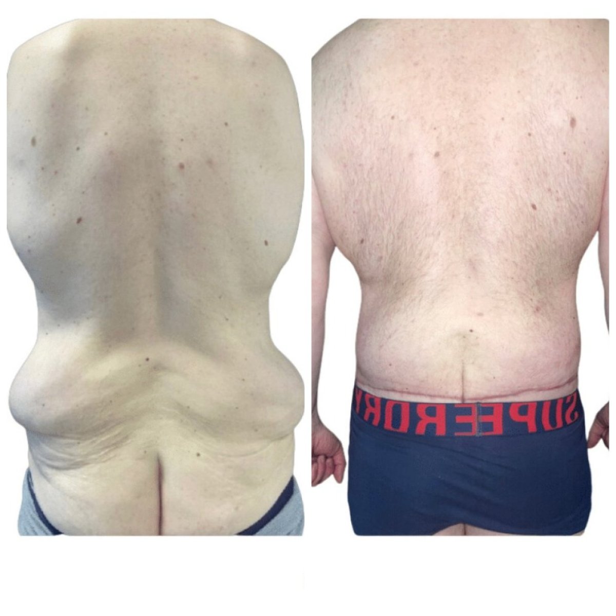 Resultados antes y después de lifting corporal completo en Michaël Benoilid Cirujano París Francia