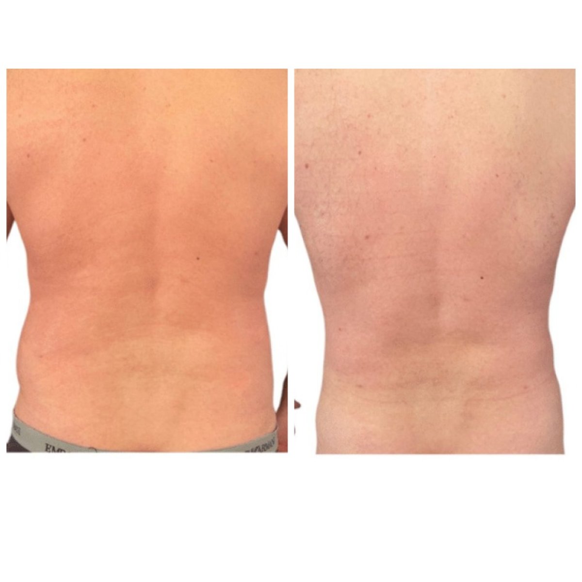 Vorher-nachher-Ergebnisse der Rückenliposuktion bei Michaël Benoilid Plastic and Cosmetic Surgeon Paris