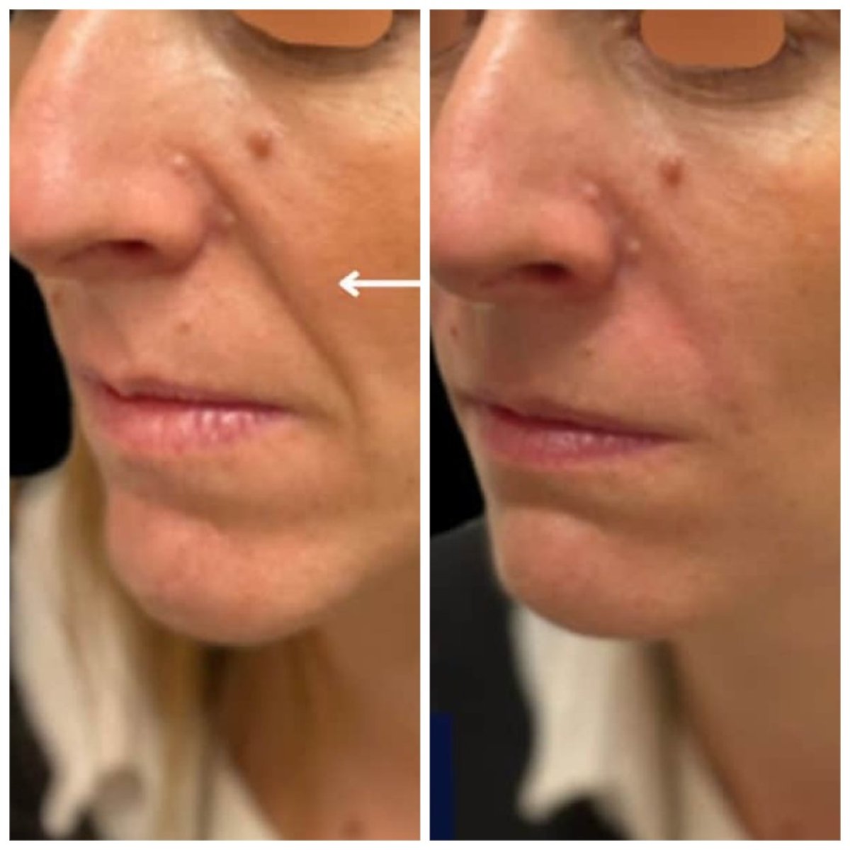 Before and after fillers injection result at Michaël Benoilid Plastic and Cosmetic Surgeon Paris France