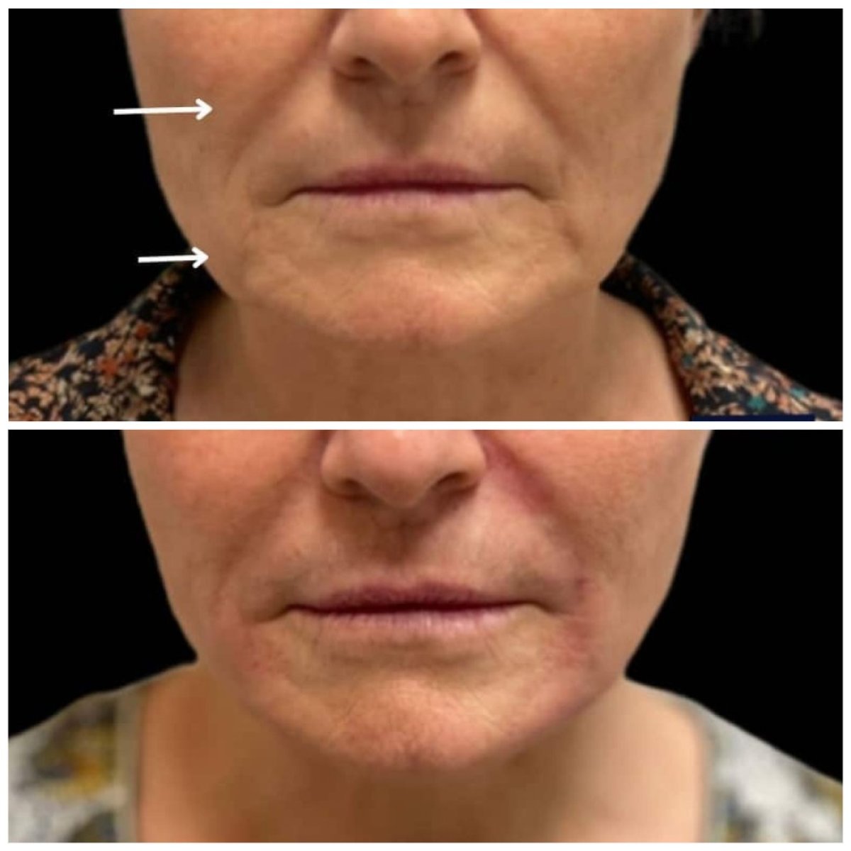 Before and after fillers injection result at Michaël Benoilid Plastic and Cosmetic Surgeon Paris France