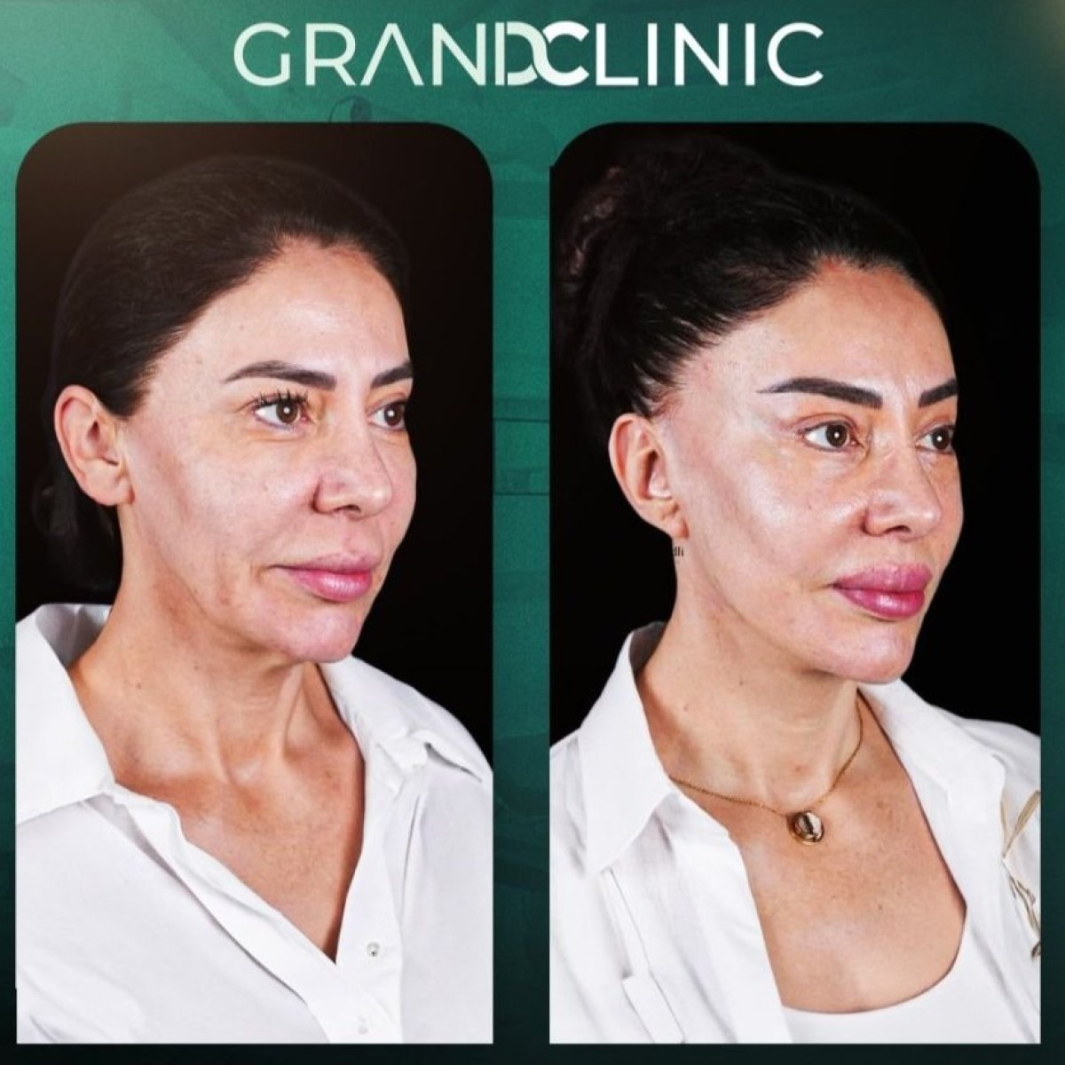 Before and after facelift results at Grand Clinic – visible facial rejuvenation and lift