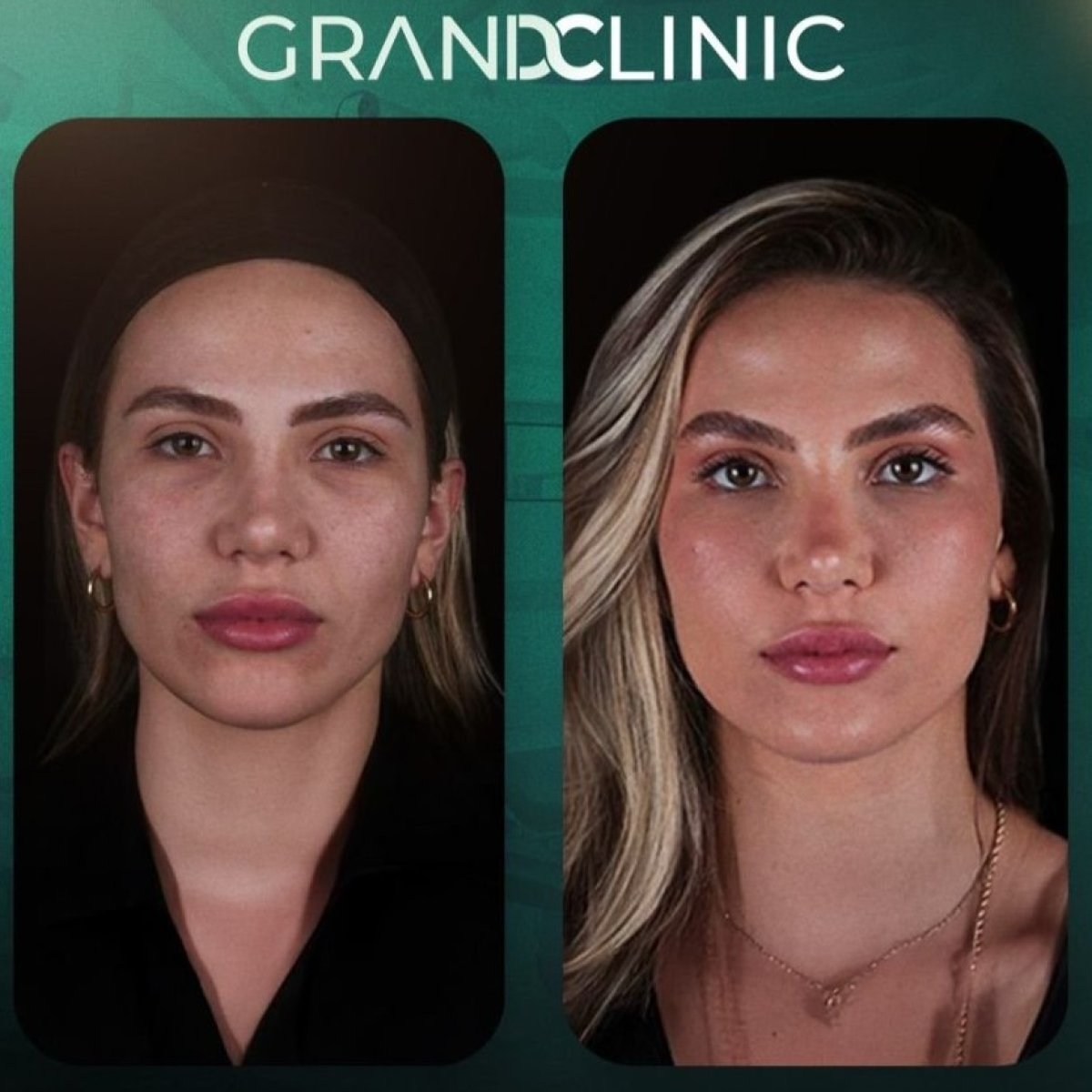 نتائج شد الوجه قبل وبعد في Grand Clinic – تجديد شباب الوجه وتحسين الملامح