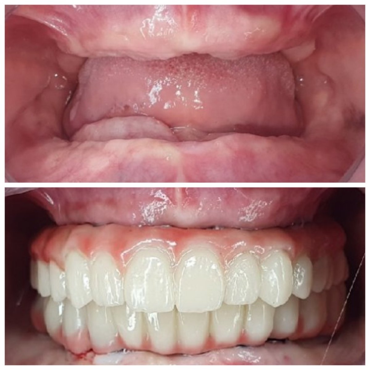 Resultados antes y después de implantes dentales All-on-6 – restauración total de la sonrisa