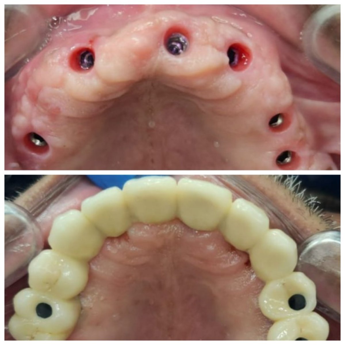 Efekt przed i po implantach All-on-6 – pełna odbudowa górnego łuku