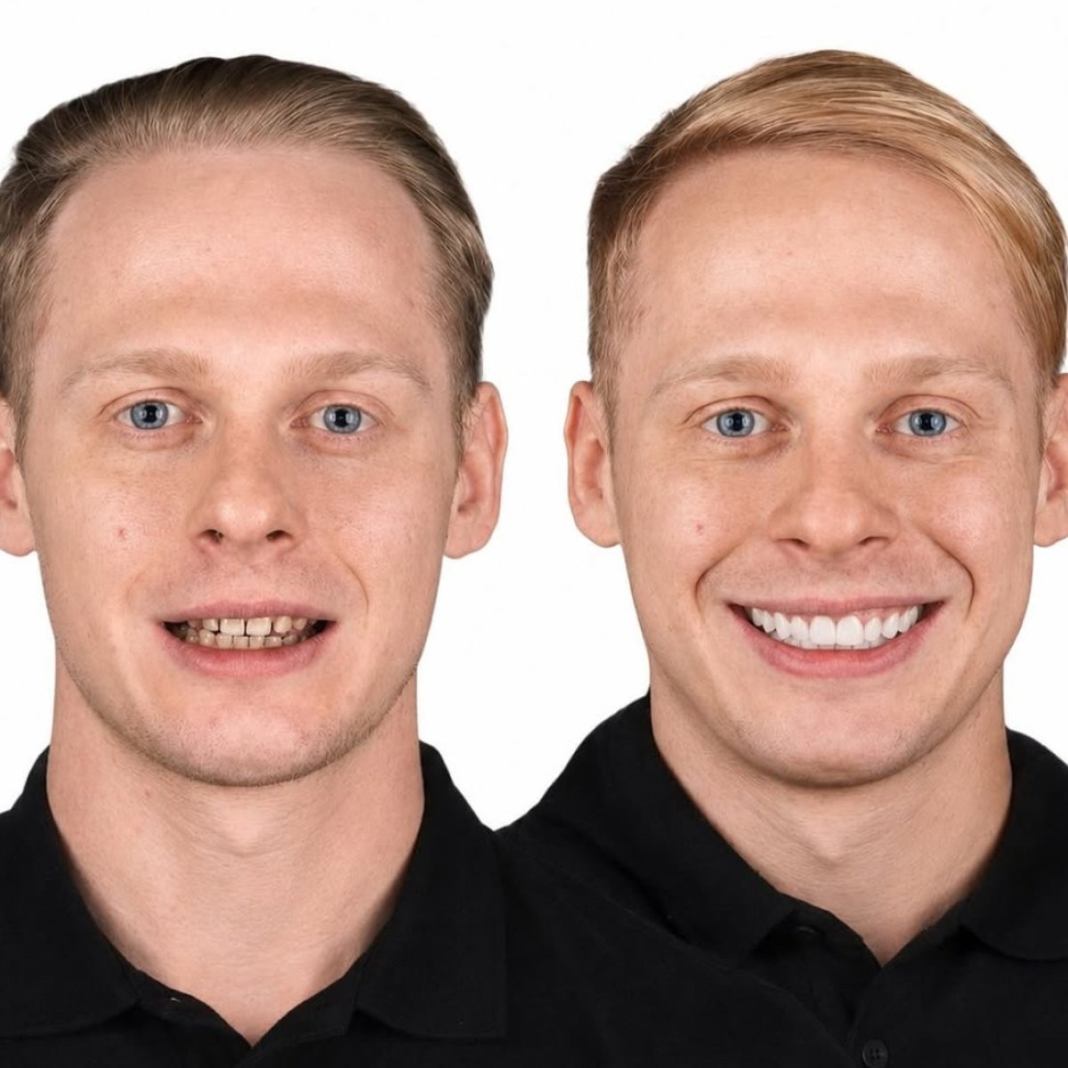 Before and after porcelain veneer results at Astra Dental Clinic, improved smile aesthetics