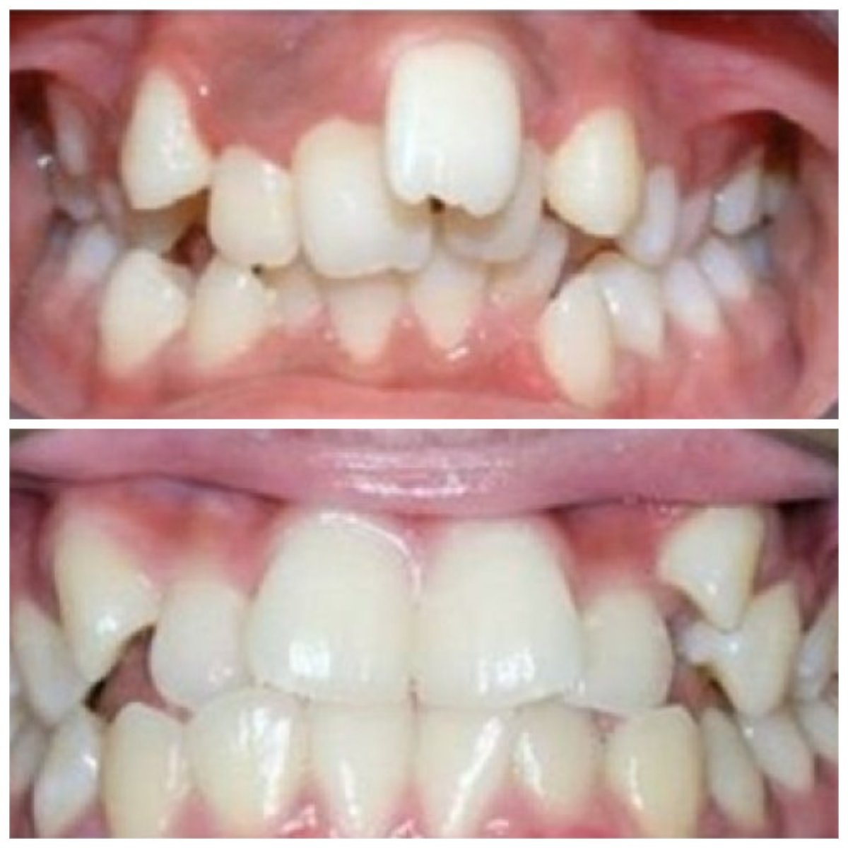 Результати до і після Invisalign у Minh Thu Dental Clinic, вирівнювання зубів