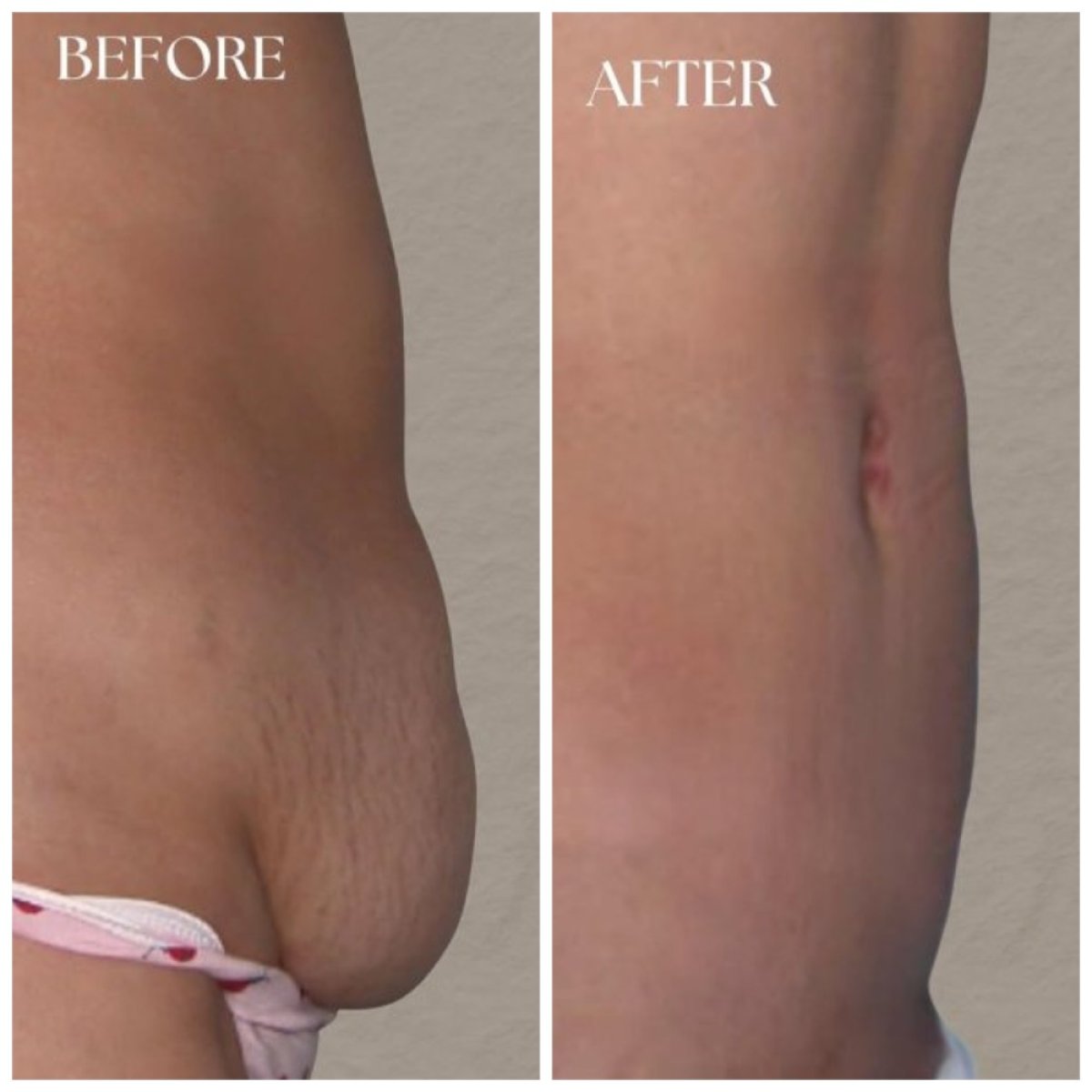 Before and after tummy tuck results at MEDICTERREAN Clinic Center, flatter abdomen visible