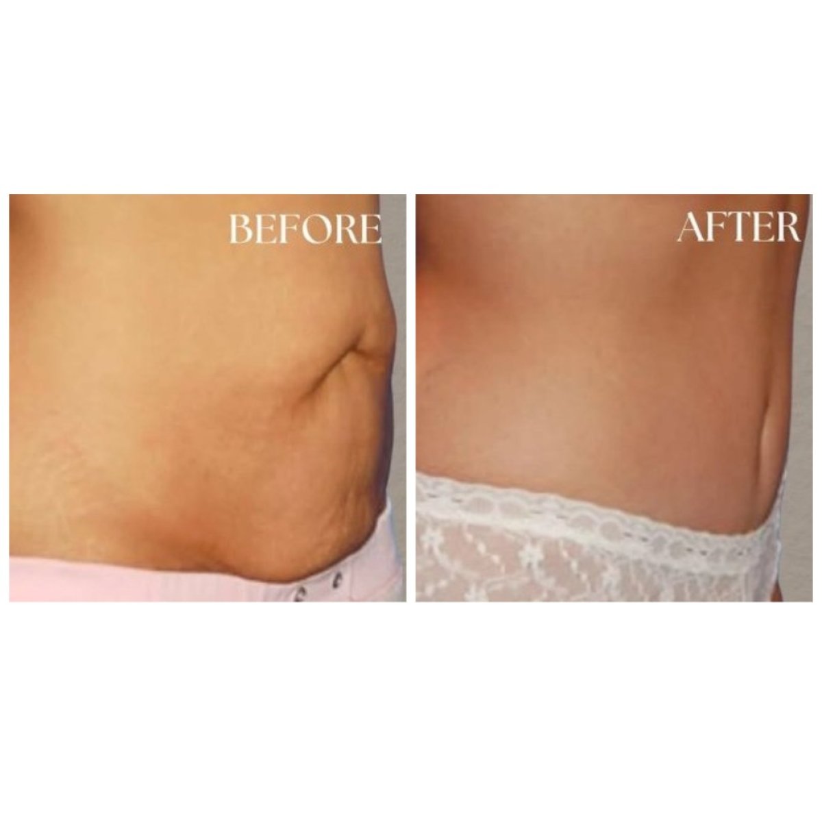 Before and after tummy tuck results at MEDICTERREAN Clinic Center, flatter abdomen shown