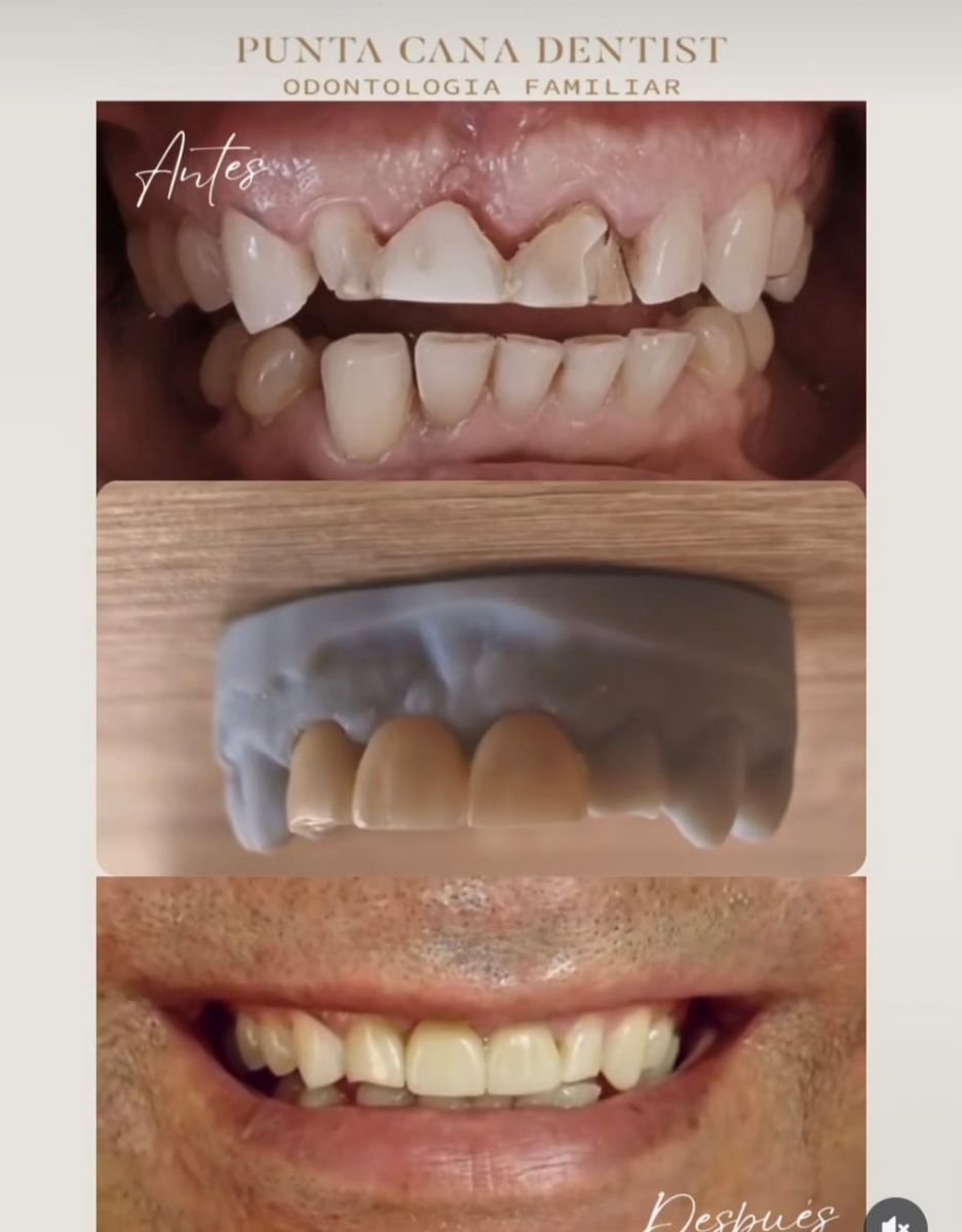Résultats avant et après smile makeover chez Punta Cana Dentist Odontologia Familiar
