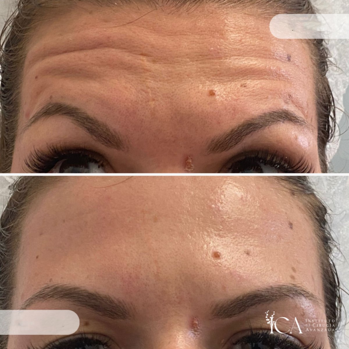 Resultados antes y después de botox en la frente en ICA, Instituto de Cirugía Estética Avanzada