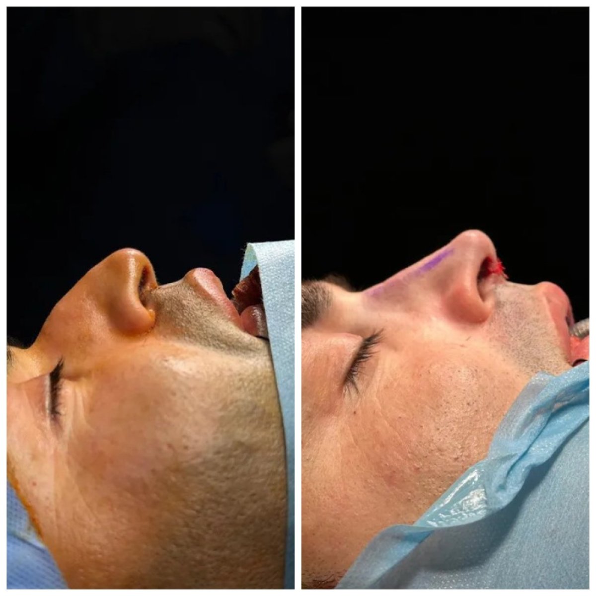 نتائج تجميل الأنف قبل وبعد في Uniqus Health، تحسين شكل ومظهر الأنف