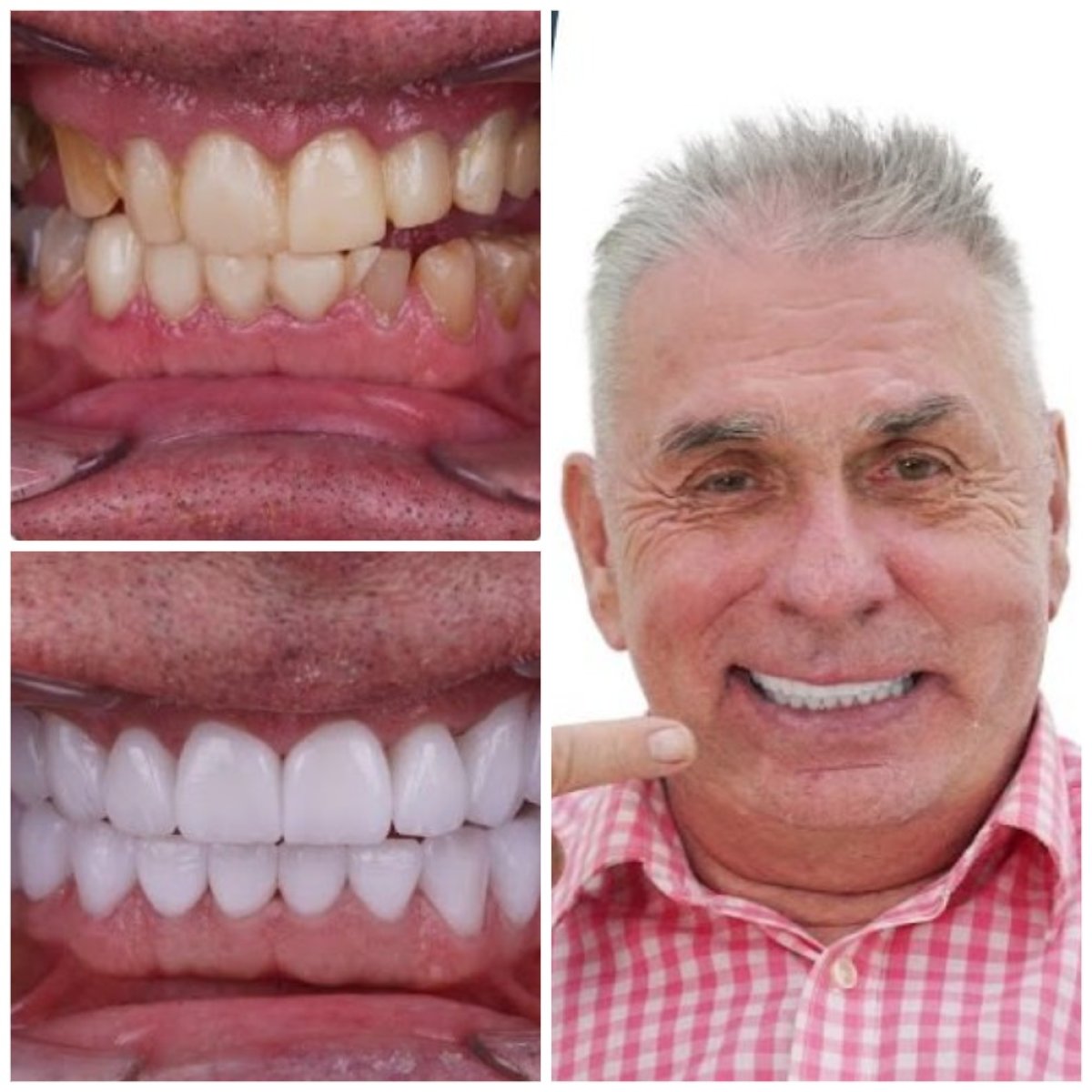 Результаты отбеливания зубов до и после в Best Dental İstanbul, сияющая улыбка