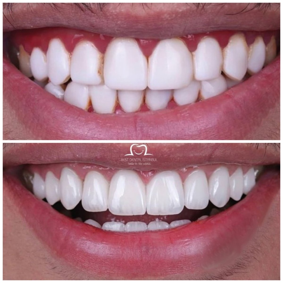 نتائج تبييض الأسنان قبل وبعد في Best Dental İstanbul، ابتسامة أكثر إشراقًا