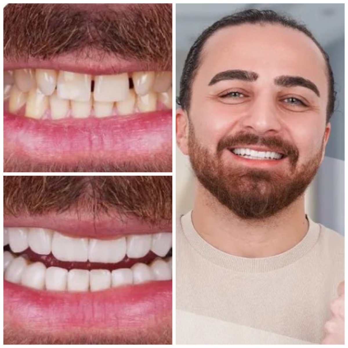 نتيجة الفينير قبل وبعد في Best Dental İstanbul – ابتسامة طبيعية وجميلة