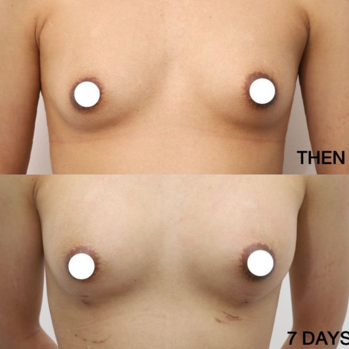Antes y después de aumento de senos con transferencia de grasa en Wansiri Hospital, 7 días