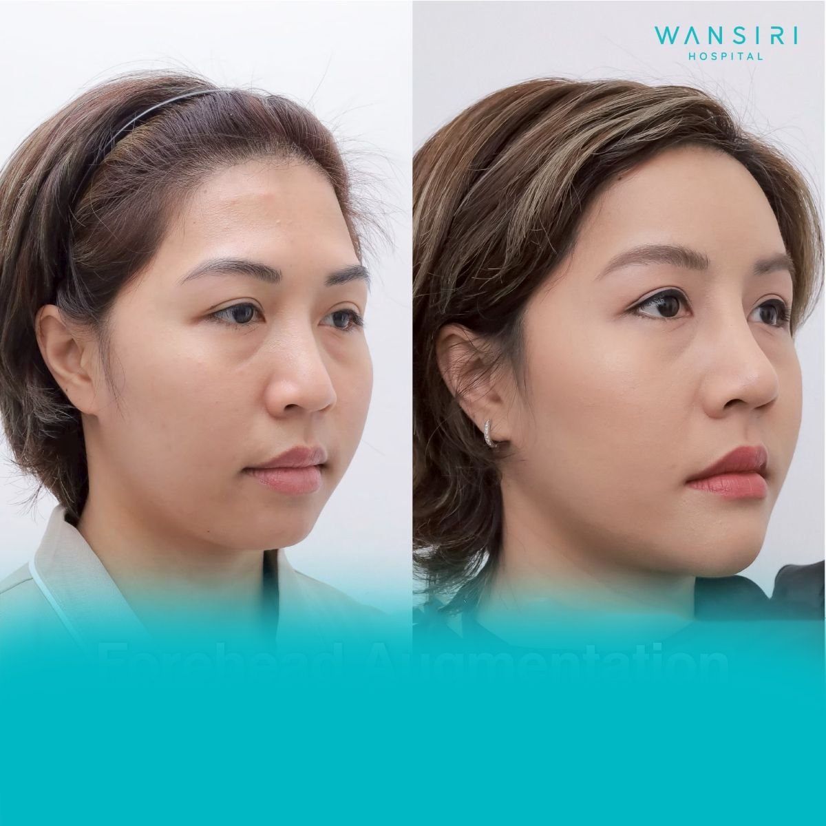 Before and after forehead augmentation implant results at Wansiri Hospital, enhanced contour