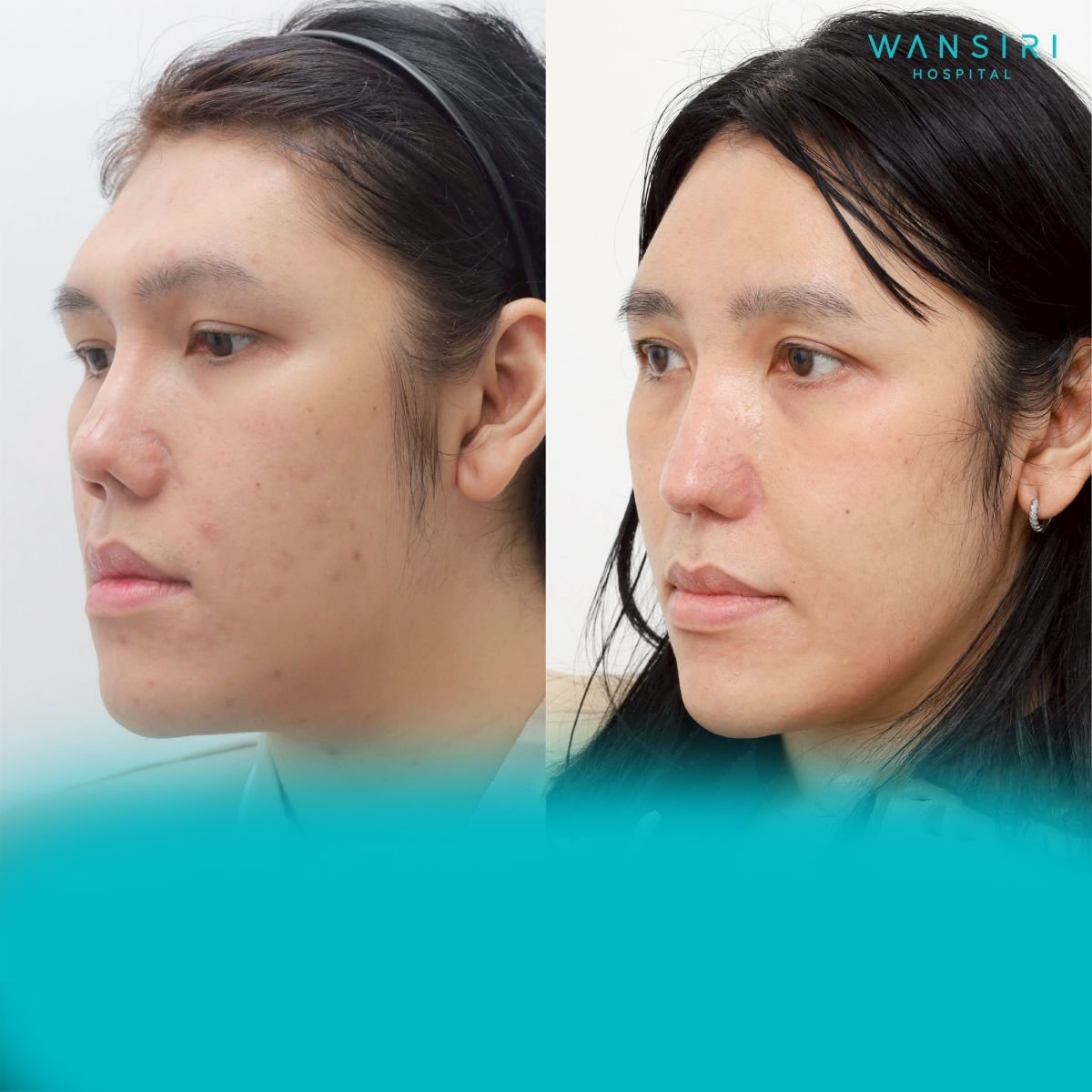 Before and after forehead augmentation (implant) results at Wansiri Hospital, facial contouring