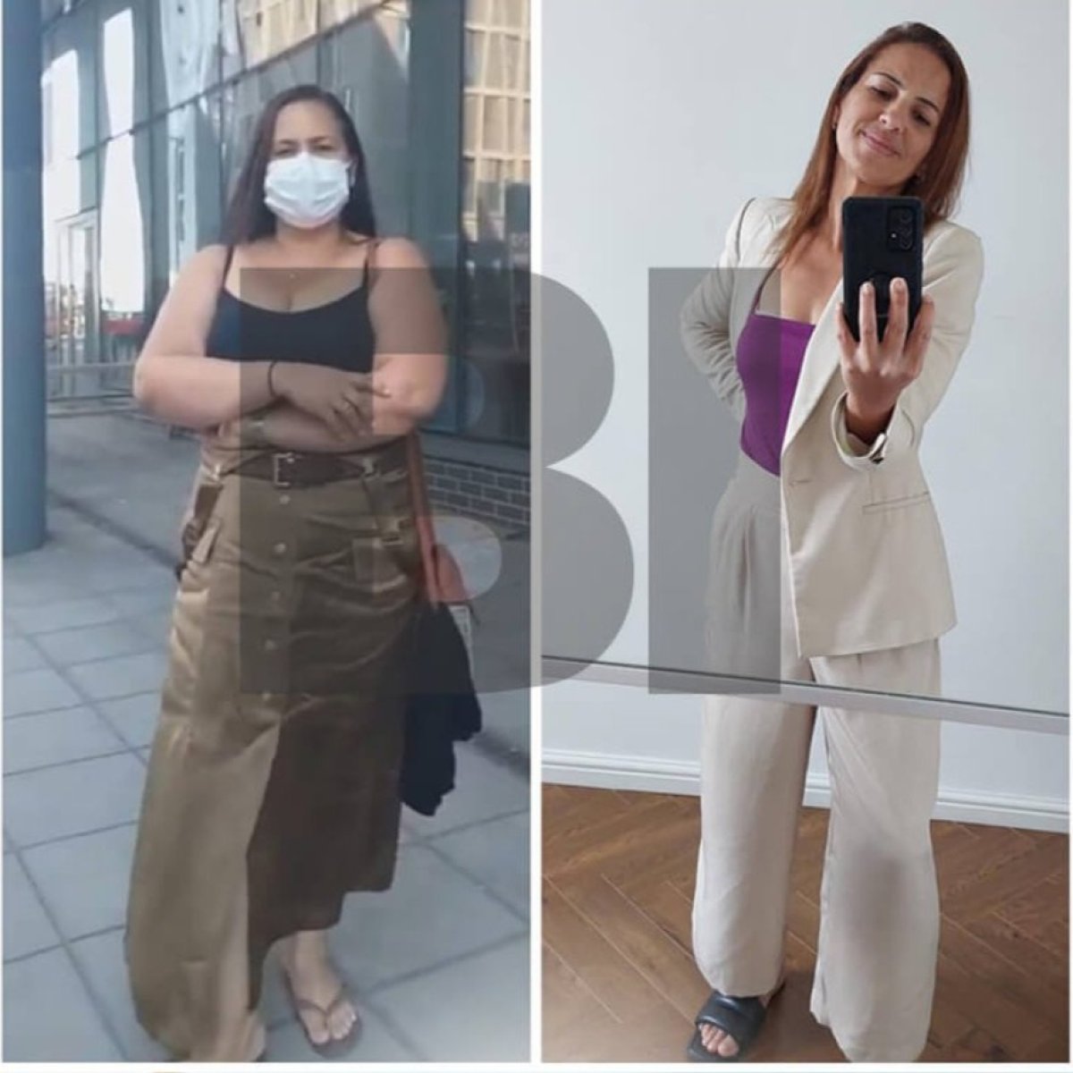 نتائج قبل وبعد تكميم المعدة في Bariatric Istanbul – فقدان وزن ملحوظ