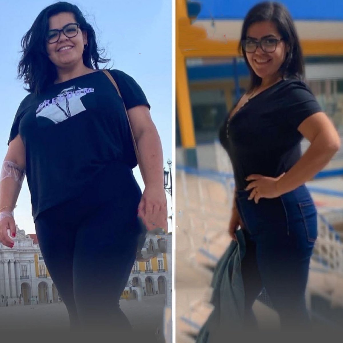 نتائج قبل وبعد عملية تكميم المعدة في Bariatric Istanbul – فقدان وزن ملحوظ
