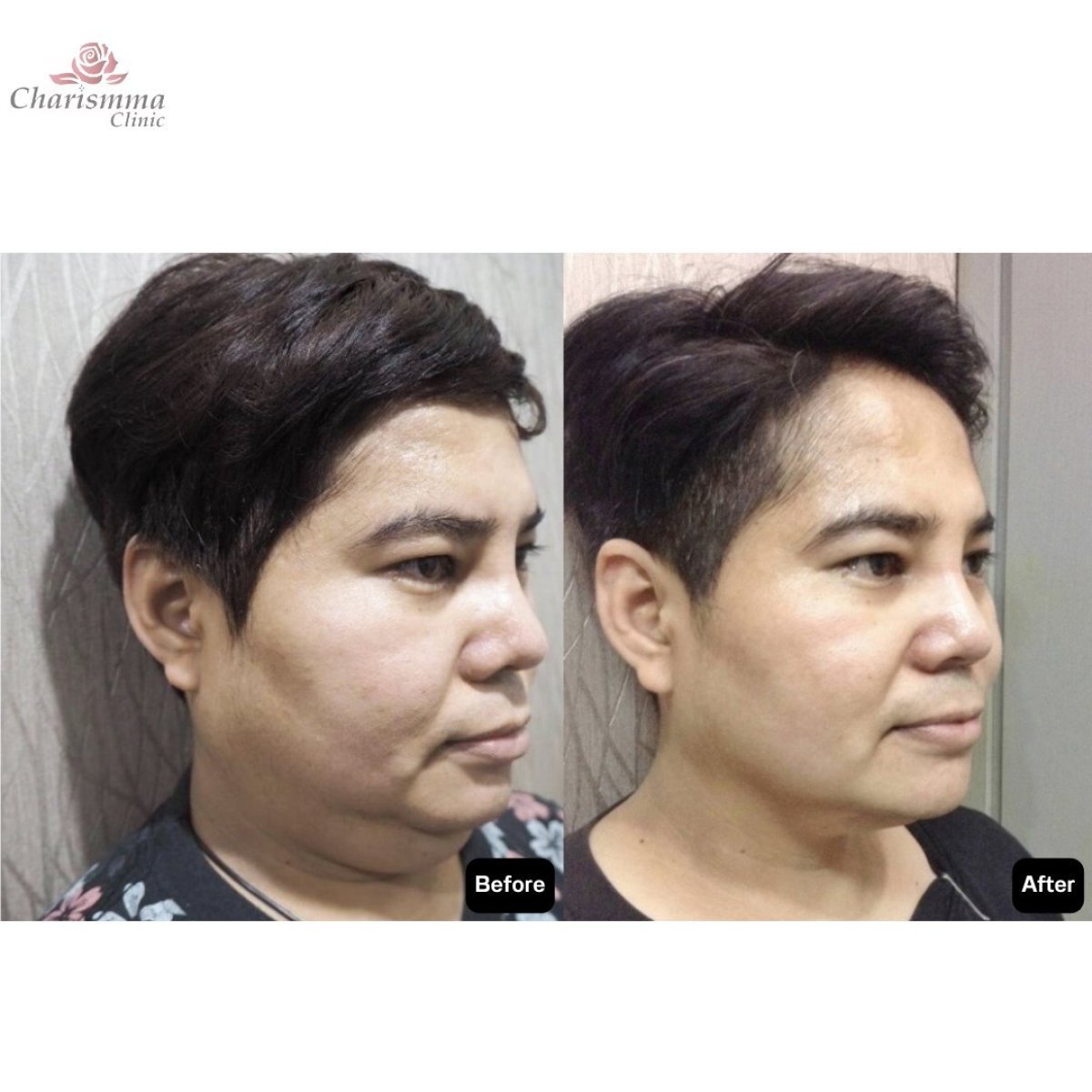 Résultats avant/après liposuccion à Charismma Clinic, contour du visage amélioré