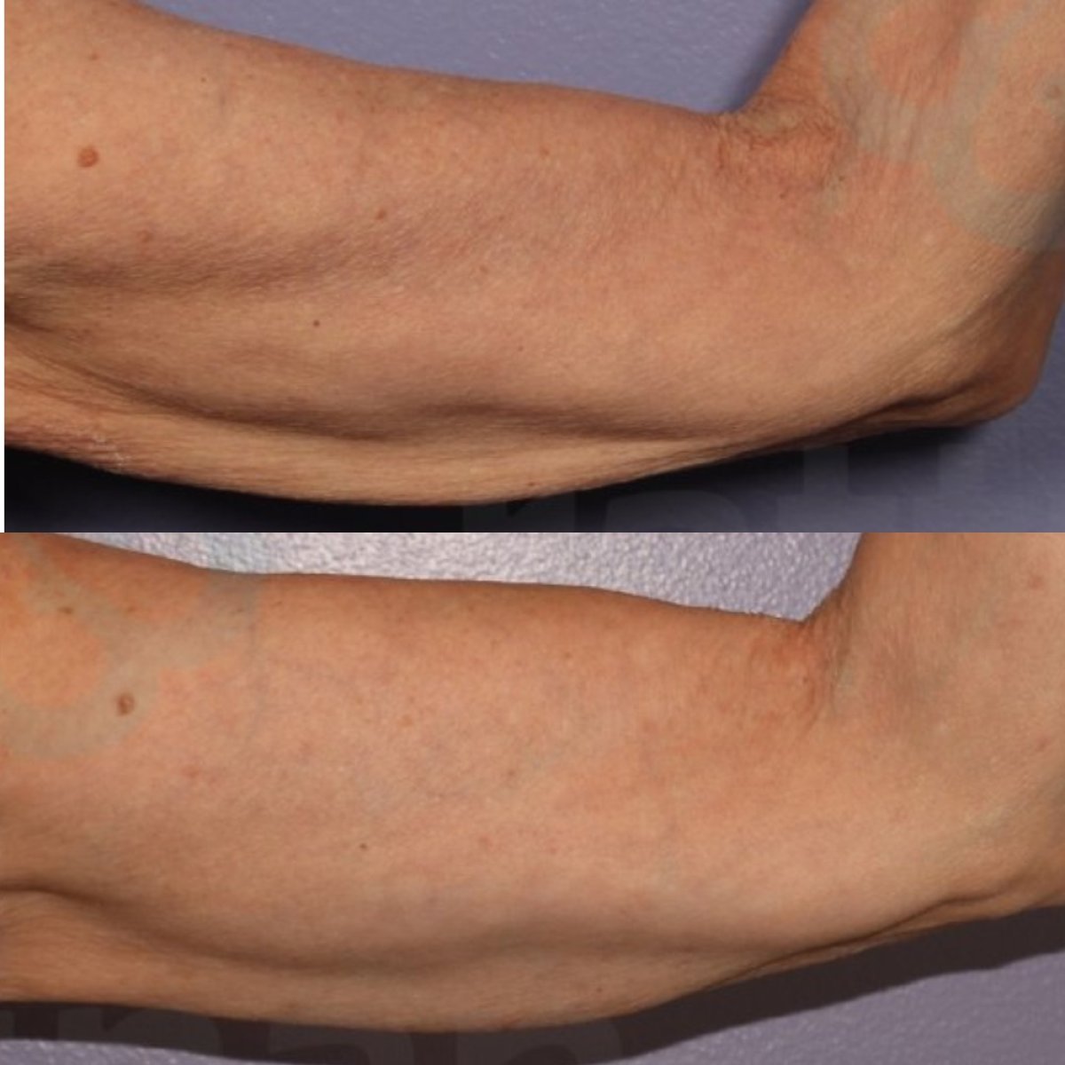 Résultats avant et après lifting des bras à la Sarinya Clinic, contour du bras amélioré