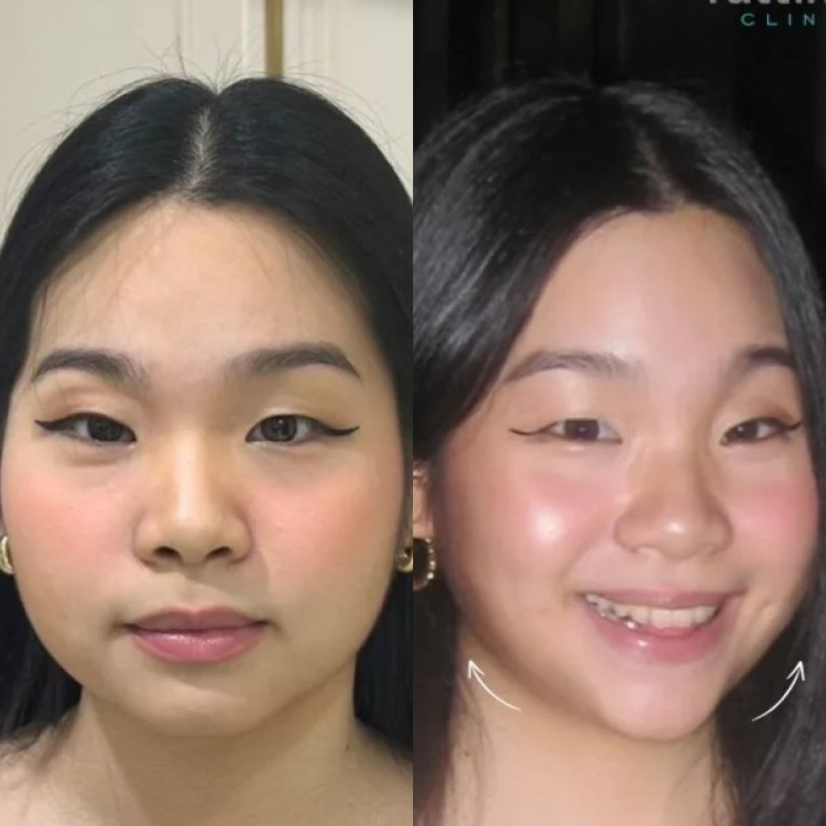 Before and after Thermage results at Sarinya Clinic – visible facial contour improvement