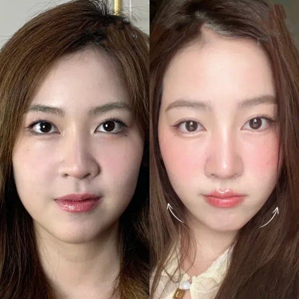 Before and after Thermage results at Sarinya Clinic – facial skin tightening and contouring