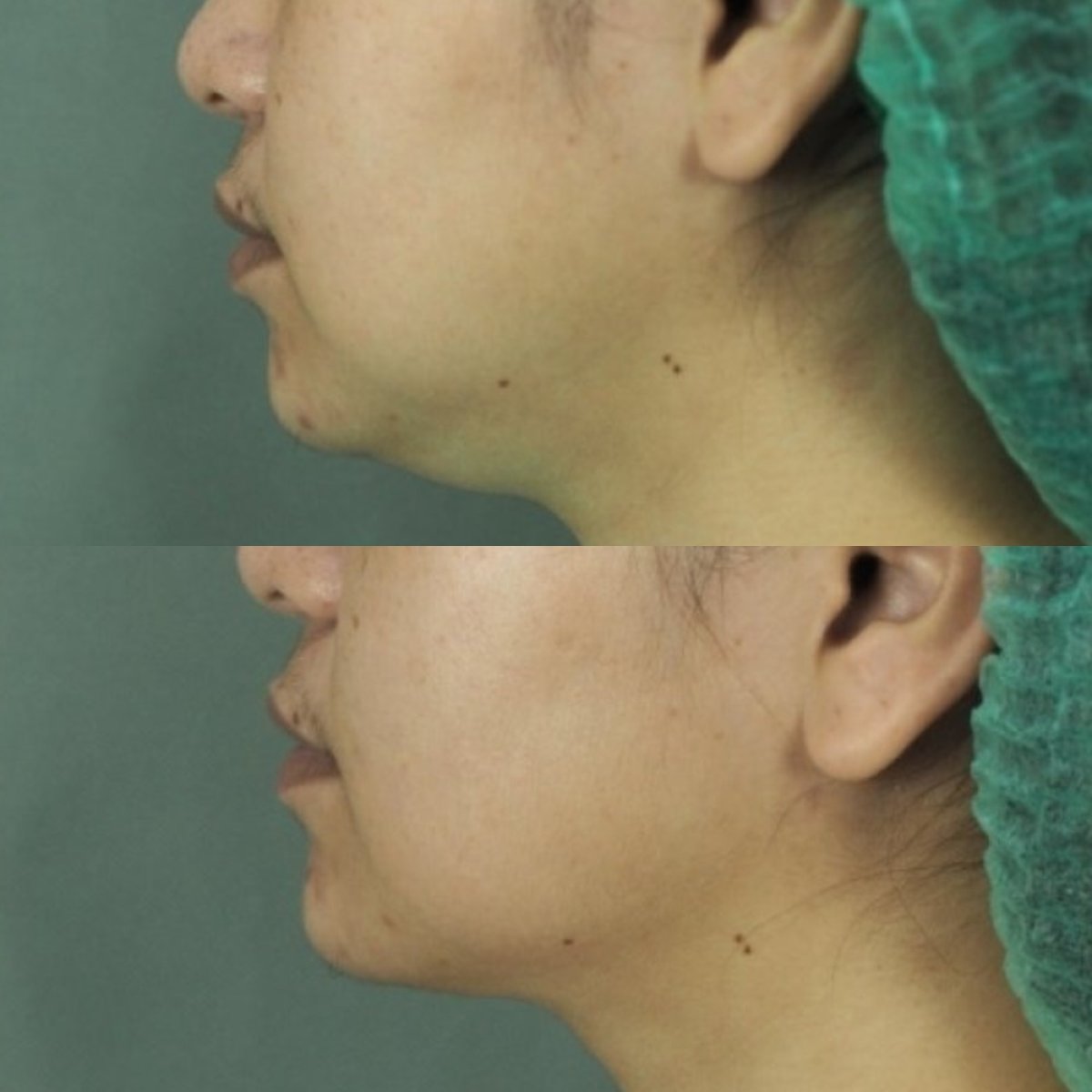 Before and after chin liposuction results at Sarinya Clinic – improved jawline contour