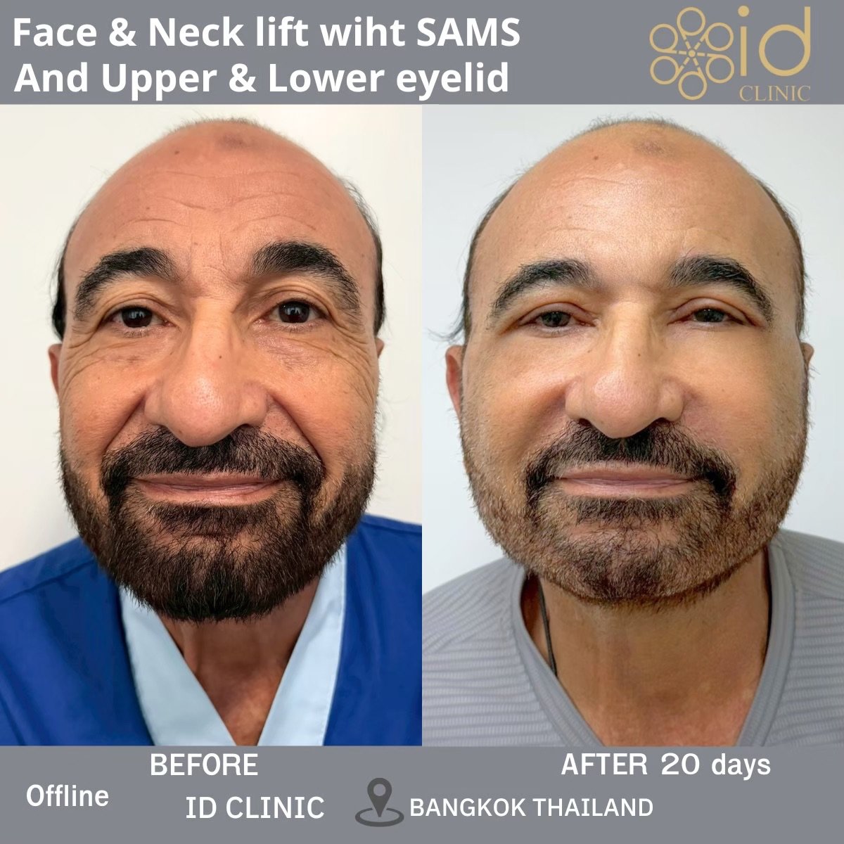 Resultados antes y después de lifting facial y de cuello con blefaroplastia en ID Clinic Bangkok