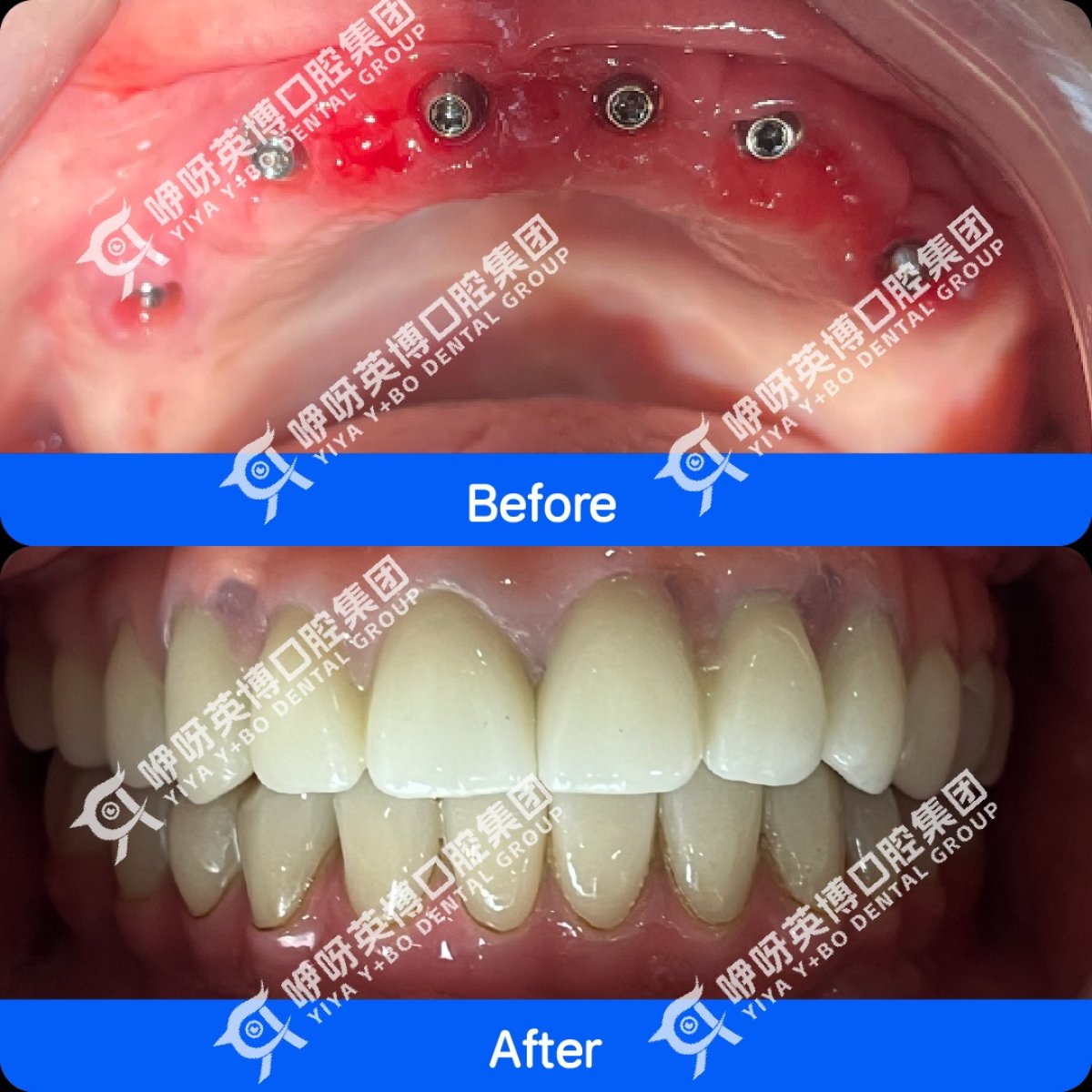 نتائج قبل وبعد زراعة أسنان All-on-4 الفورية في عيادة Shanghai Y+bo Dental Clinic