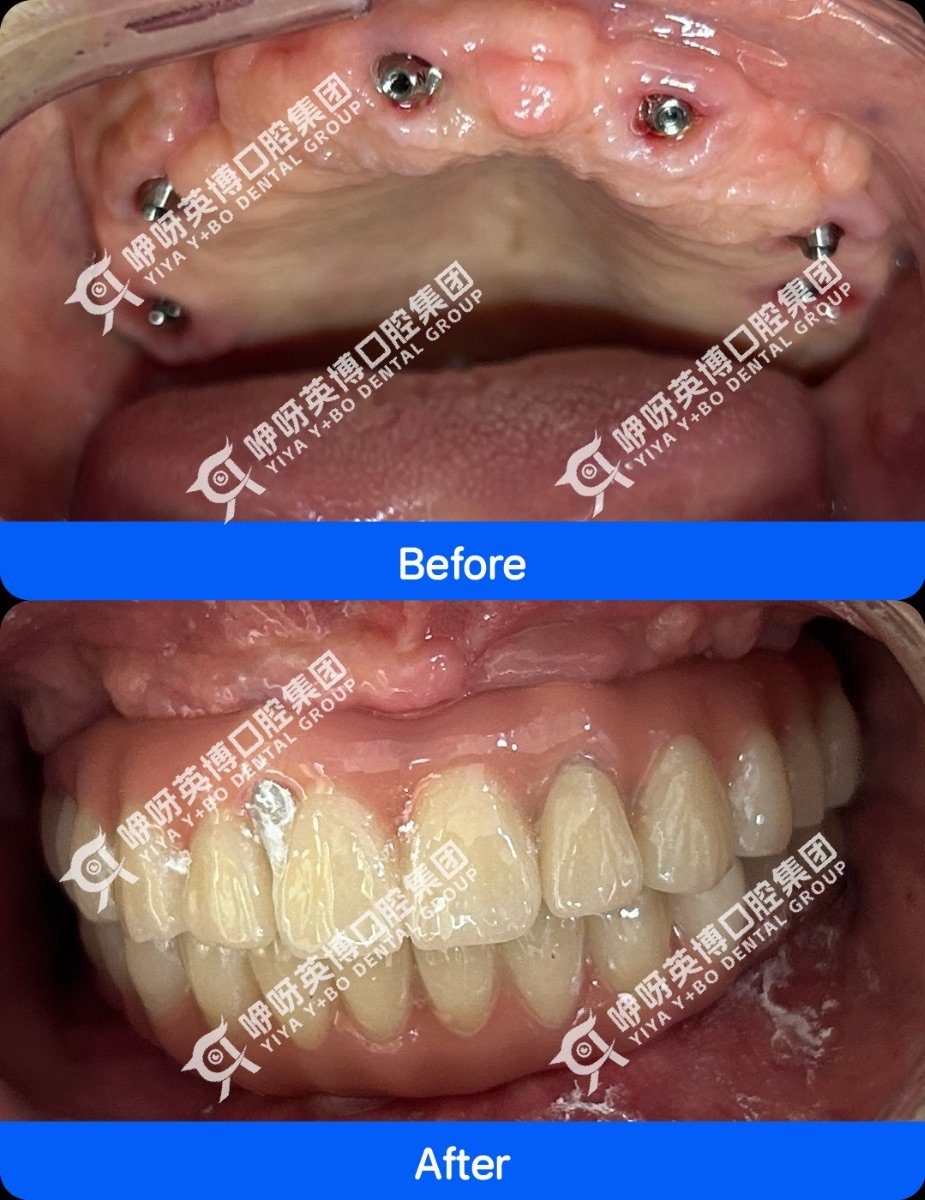 نتيجة قبل وبعد زراعة الأسنان الفورية All-on-4 في عيادة Shanghai Y+bo Dental Clinic