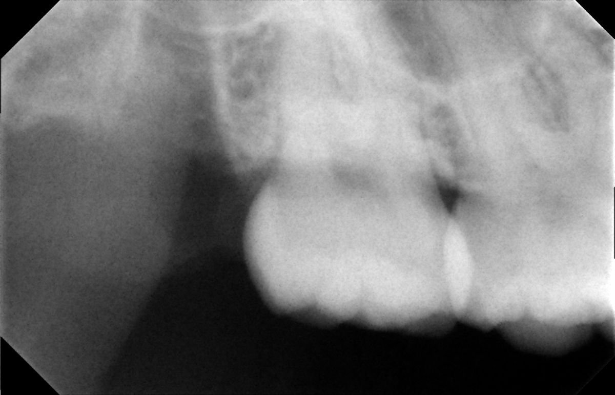Radiographie après extraction de dent de sagesse à SoftDentalCare Clinic, résultat visible