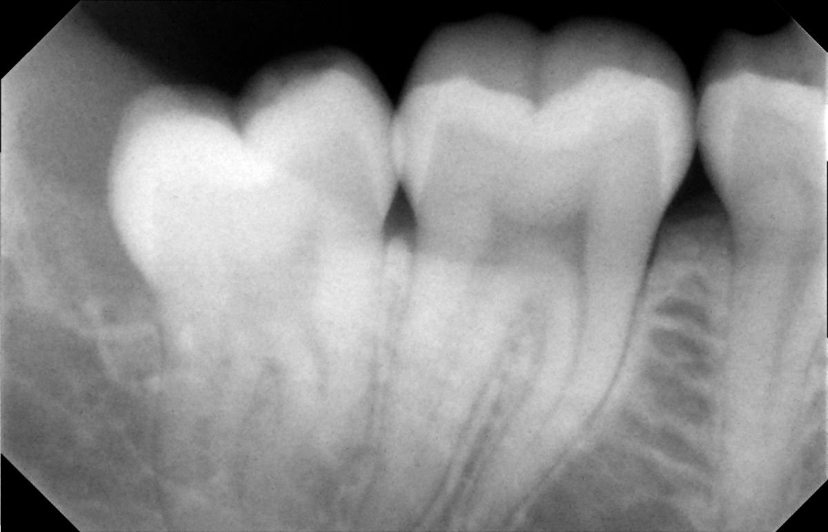 Résultat radiographique après extraction de dent de sagesse à SoftDentalCare Clinic