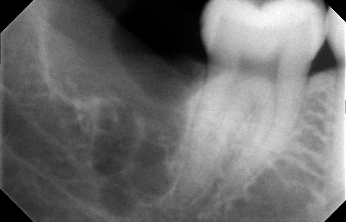 Radiografía antes de extracción de muela del juicio en SoftDentalCare Clinic, resultado diagnóstico